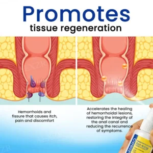 🌟 Official Store | Cvreoz® Herbal Hemorrhoids Fast-Acting Treatment Spray – Your Quick Relief Solution!