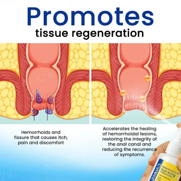 🌟 Official Store | Cvreoz® Herbal Hemorrhoids Fast-Acting Treatment Spray – Your Quick Relief Solution!
